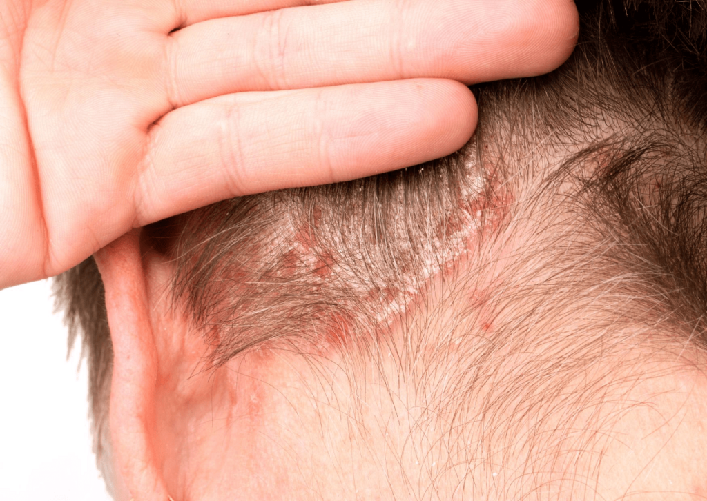 ¿Tiene cura la dermatitis seborreica? Esto dicen los expertos