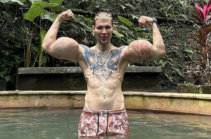 “Popeye ruso” podría perder los brazos tras años de inyecciones riesgosas