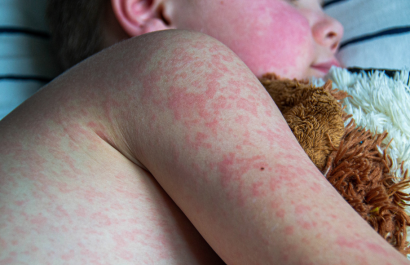 La vacunación infantil es clave para la prevención del sarampión.