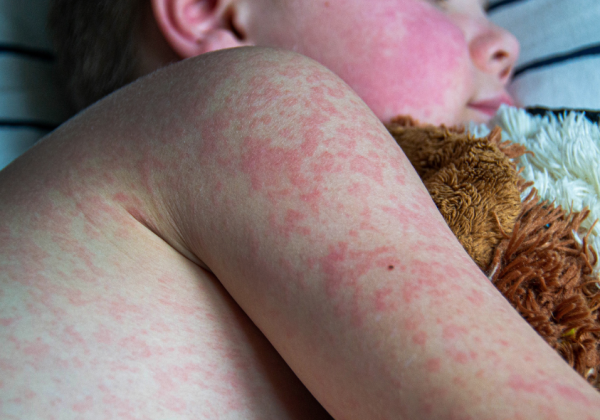 La vacunación infantil es clave para la prevención del sarampión.