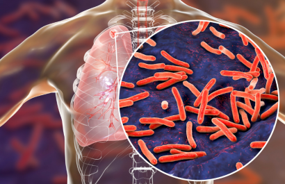 La tuberculosis (TB) es una enfermedad infecciosa que generalmente afecta a los pulmones.