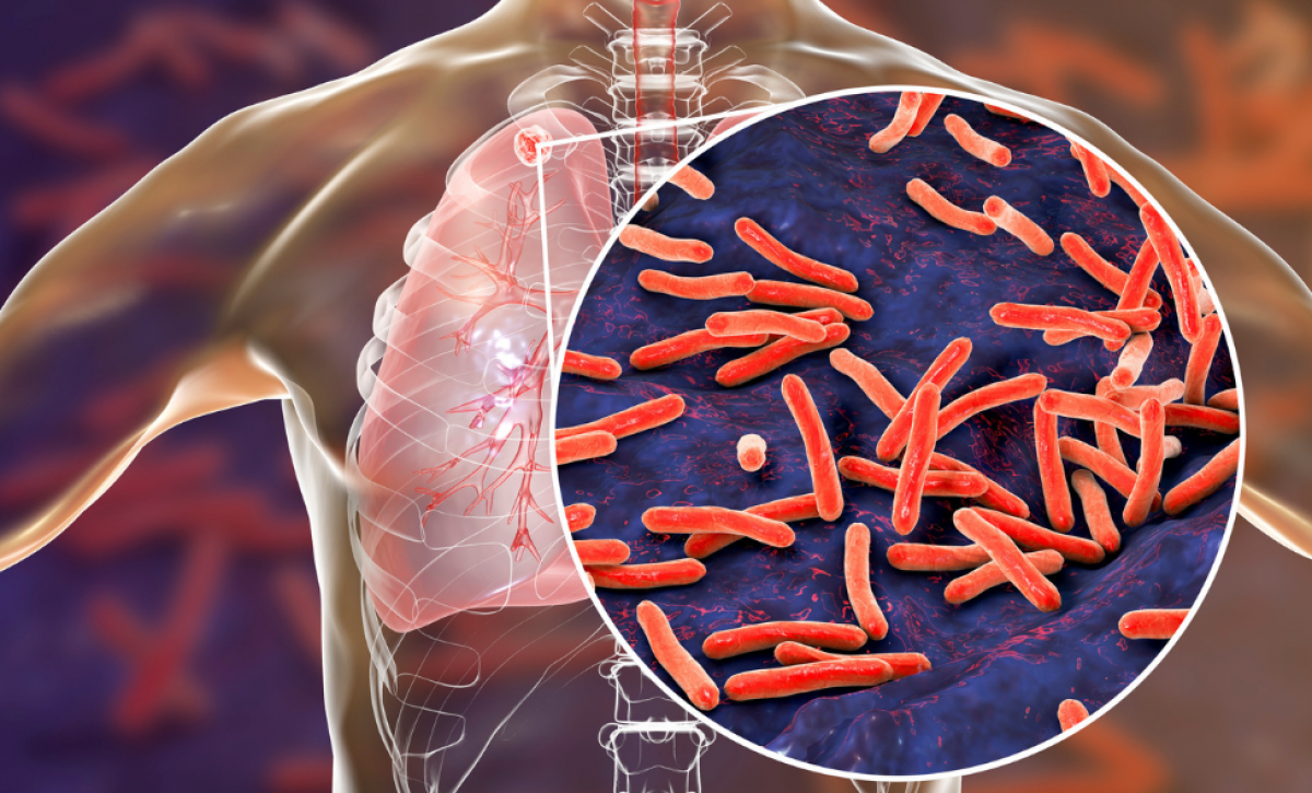 La tuberculosis (TB) es una enfermedad infecciosa que generalmente afecta a los pulmones.