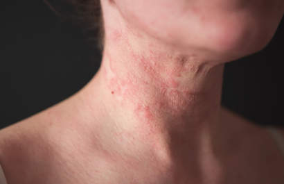 La enfermedad provoca piel extremadamente seca y un picor (prurito) intenso y persistente.