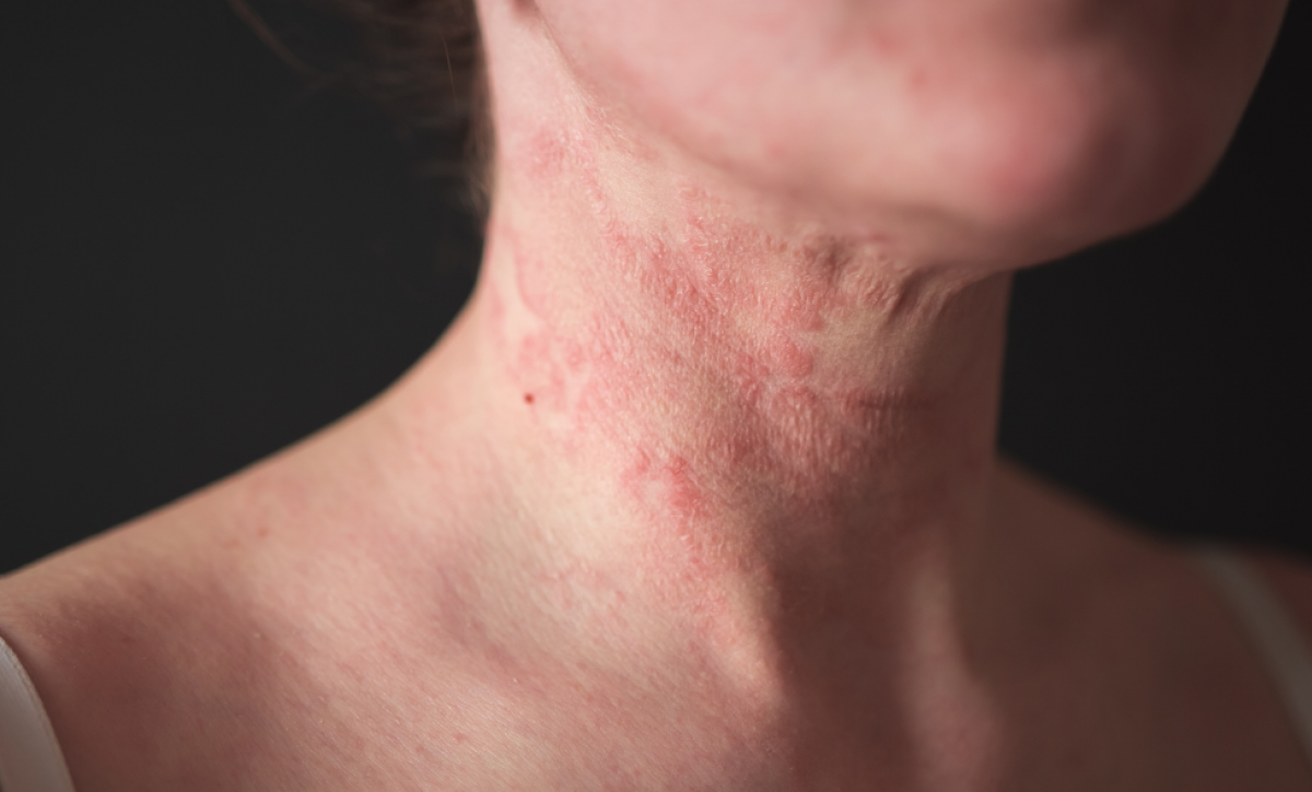 La enfermedad provoca piel extremadamente seca y un picor (prurito) intenso y persistente.