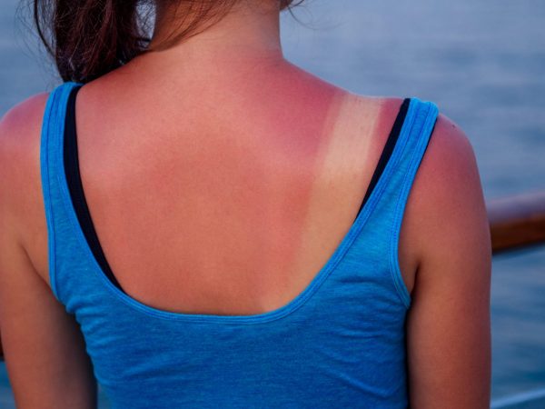 Lo que debes aplicar en tu piel para evitar daños permanentes