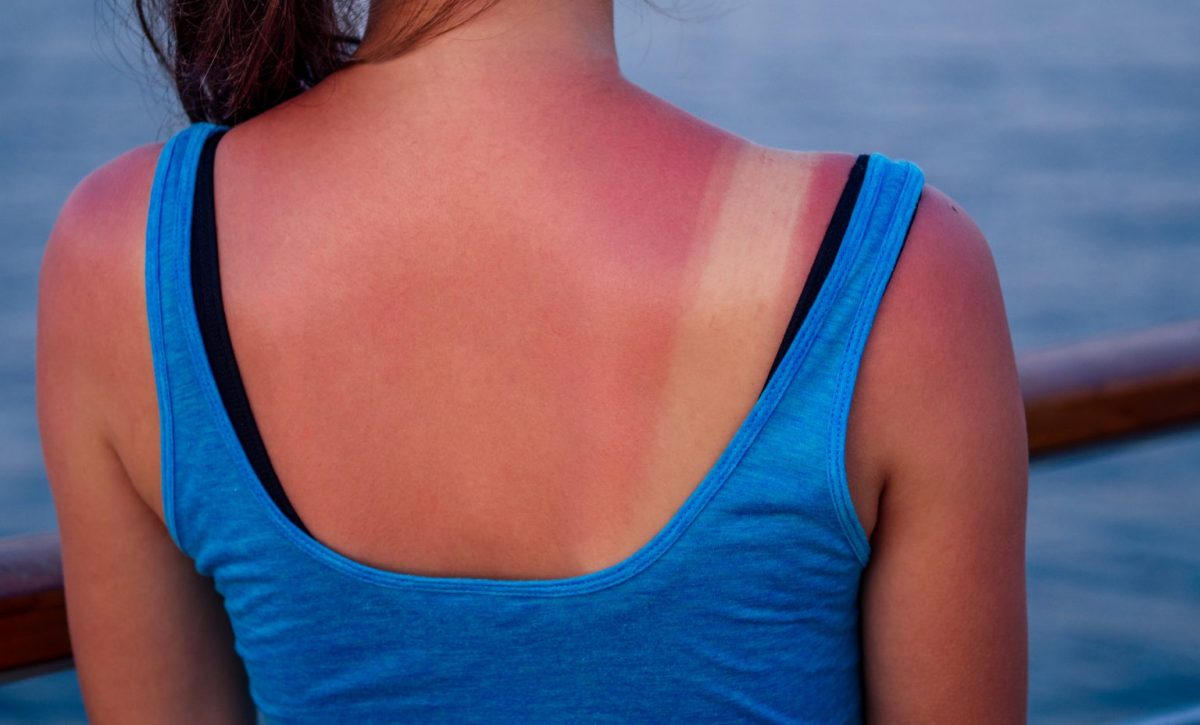 Lo que debes aplicar en tu piel para evitar daños permanentes