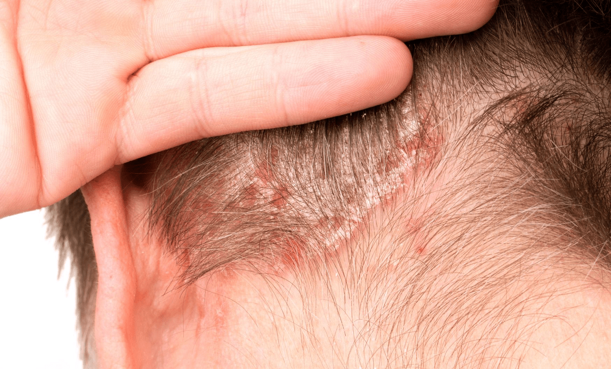 ¿Tiene cura la dermatitis seborreica? Esto dicen los expertos