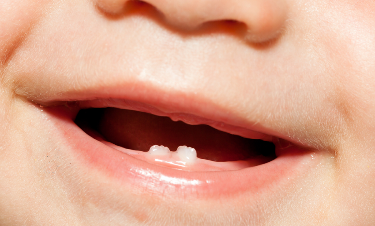 ¿Sabías que los dientes de leche afectan la salud permanente? Aprende cómo cuidarlos