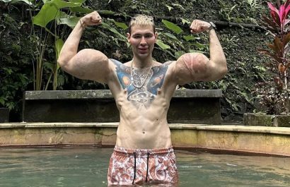 “Popeye ruso” podría perder los brazos tras años de inyecciones riesgosas