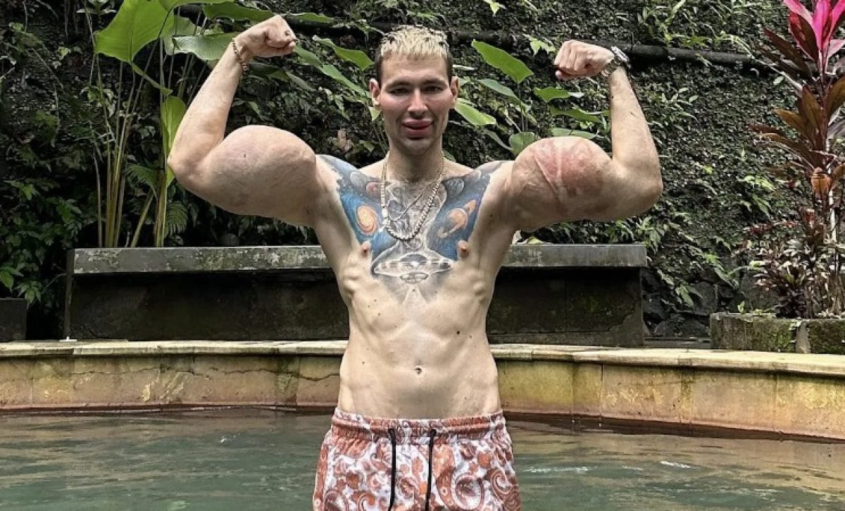 “Popeye ruso” podría perder los brazos tras años de inyecciones riesgosas